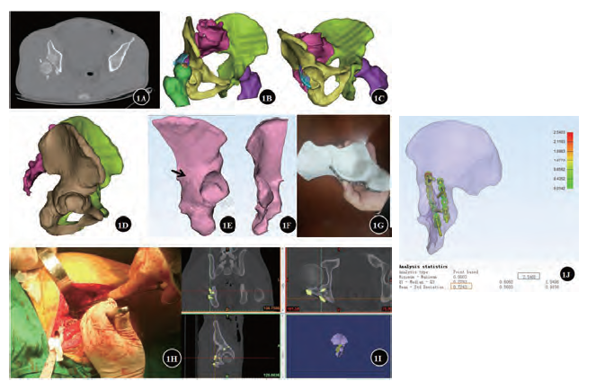 3D打印钛板塑形模板在髋臼骨折的可行性研究