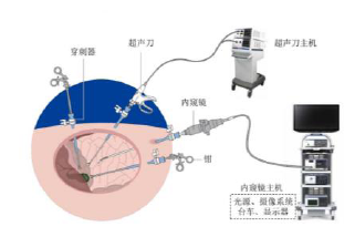 软式内窥镜市场空间广阔，国产替代扬帆起航