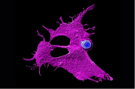 新疗法精准识别并摧毁胰腺癌细胞