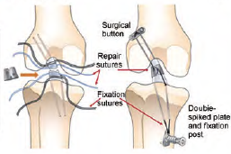 可降解镁基复合材料的制备及其在骨科领域的研究进展