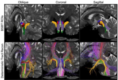 攻克脑成像技术难题&mdash;&mdash;AI算法自动解析脑干白质神经束